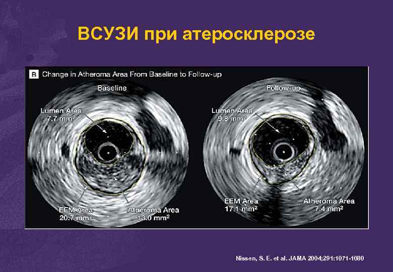 ВСУЗИ при атеросклерозе Nissen, S. E. et al. JAMA 2004; 291: 1071 -1080 