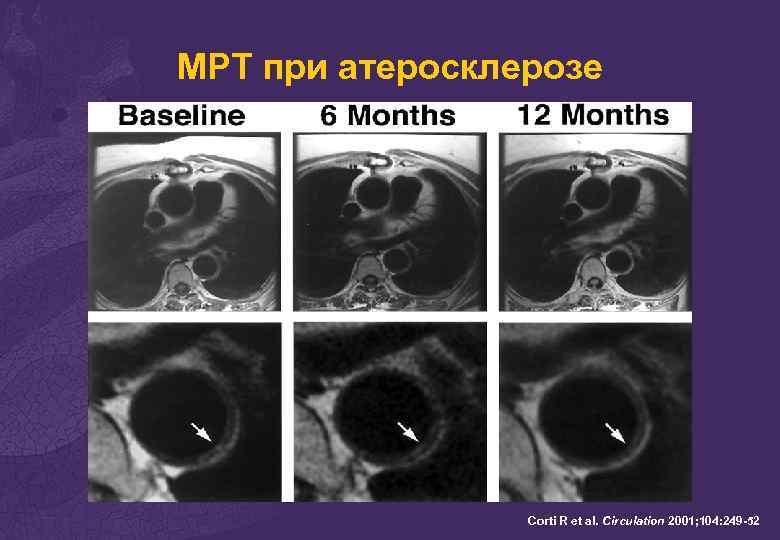 Атеросклероз мрт. Атеросклероз сосудов головного мозга на кт. Атеросклероз сосудов на мрт. Атеросклероз сосудов головного мозга YF RN.