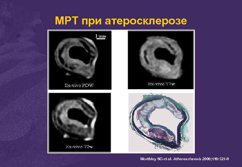 Атеросклероз мрт. Атеросклероз сосудов головного мозга мрт. Атеросклероз сосудов на мрт. Атеросклероз на мрт головного мозга.