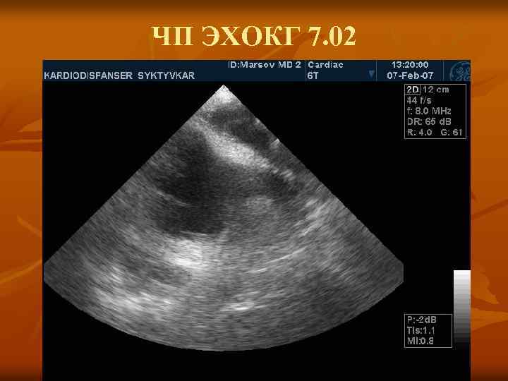 ЧП ЭХОКГ 7. 02 