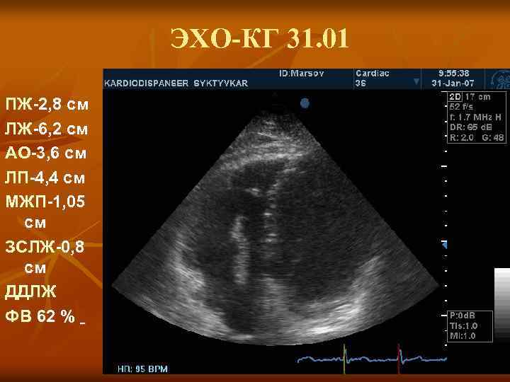 ЭХО-КГ 31. 01 ПЖ-2, 8 см ЛЖ-6, 2 см АО-3, 6 см ЛП-4, 4