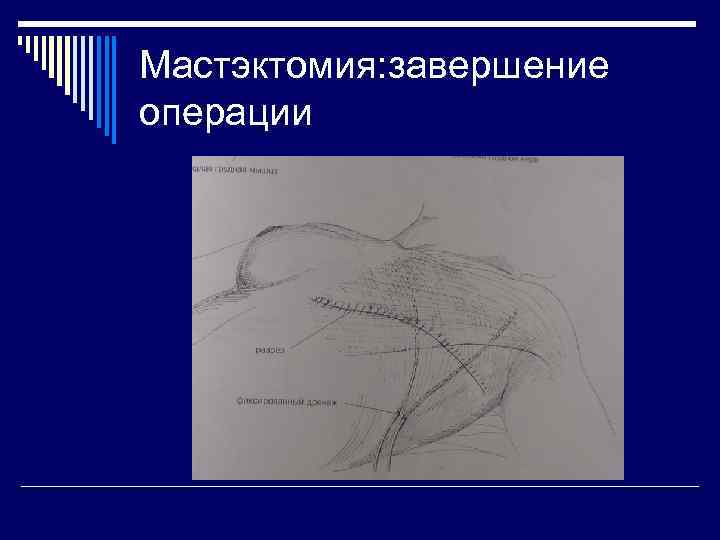 Мастэктомия: завершение операции 