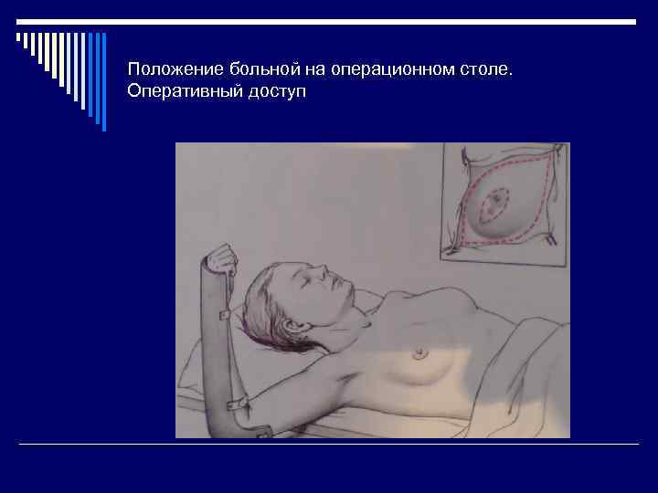 Положение больной на операционном столе. Оперативный доступ 