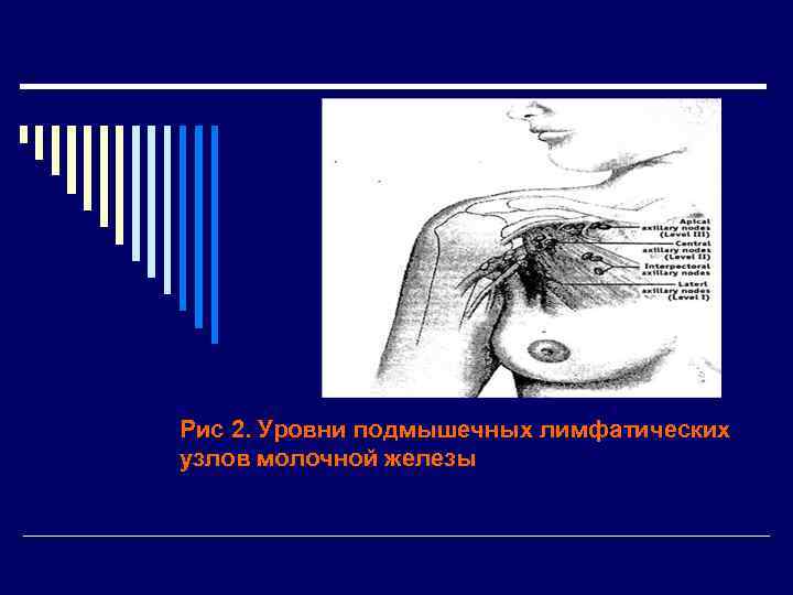 Рис 2. Уровни подмышечных лимфатических узлов молочной железы 