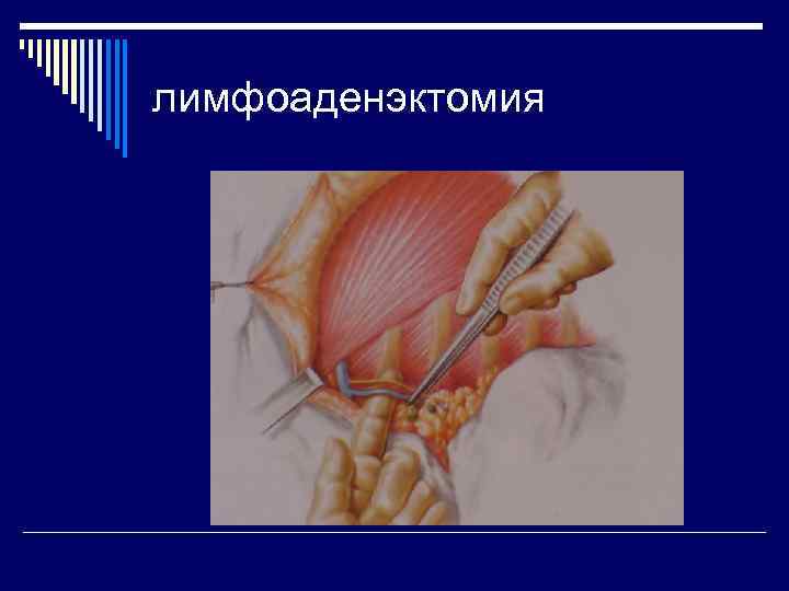 лимфоаденэктомия 