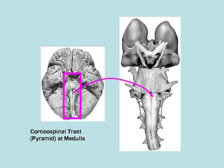 Corticospinal Tract (Pyramid) at Medulla 