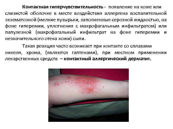Контактная гиперчувствительность - появление на коже или слизистой оболочке в месте воздействия аллергена воспалительной