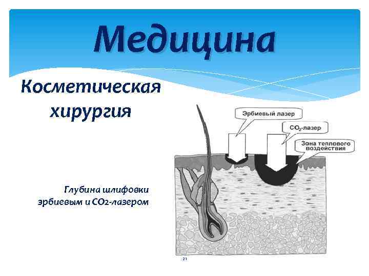 Медицина Косметическая хирургия Глубина шлифовки эрбиевым и СО 2 -лазером 21 