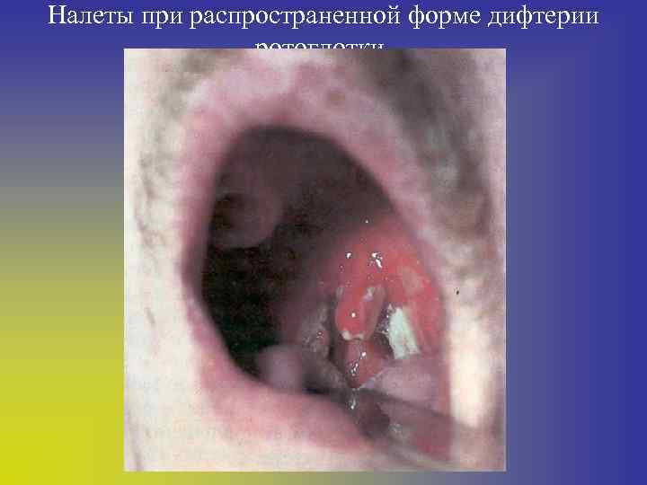 Налеты при распространенной форме дифтерии ротоглотки. 