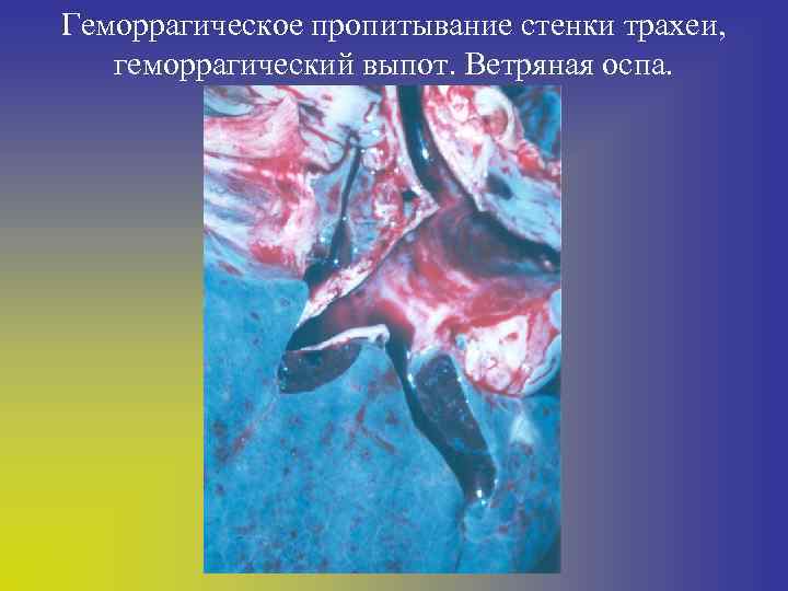 Геморрагическое пропитывание стенки трахеи, геморрагический выпот. Ветряная оспа. 