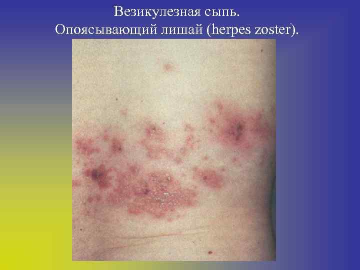 Везикулезная сыпь. Опоясывающий лишай (herpes zoster). 