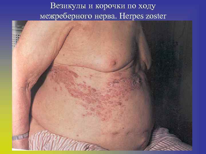 Везикулы и корочки по ходу межреберного нерва. Herpes zoster 