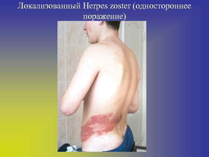 Локализованный Herpes zoster (одностороннее поражение) 