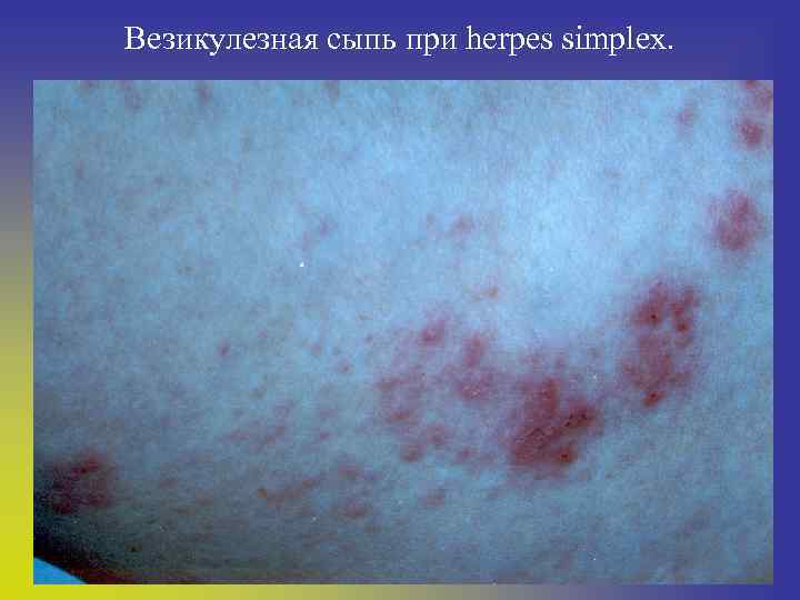 Везикулезная сыпь при herpes simplex. 