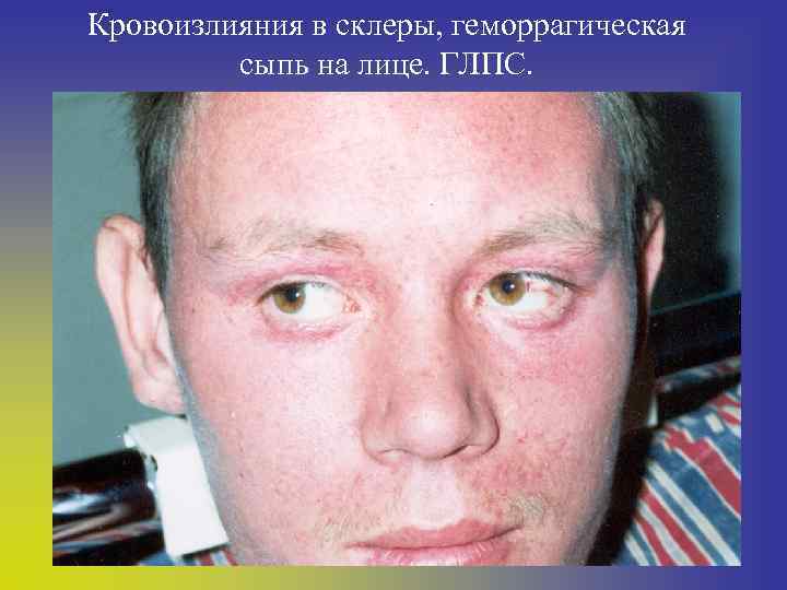 Кровоизлияния в склеры, геморрагическая сыпь на лице. ГЛПС. 