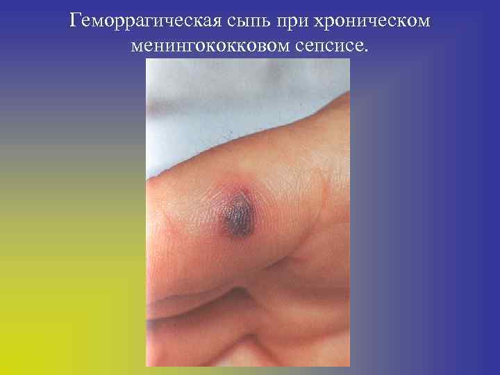 Геморрагическая сыпь при хроническом менингококковом сепсисе. 