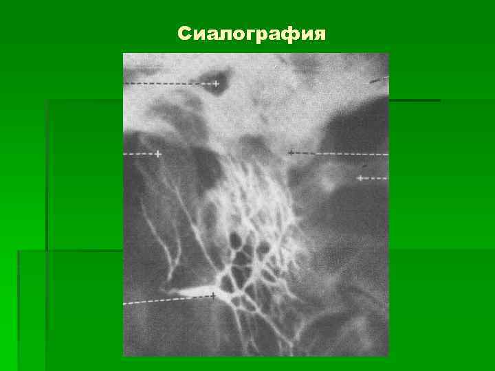 Сиалография 