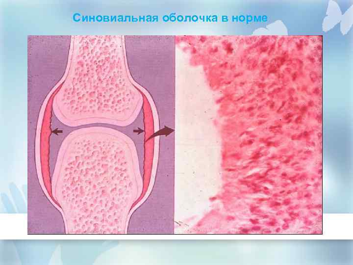 Синовиальная оболочка в норме 