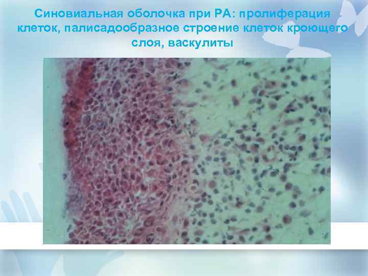 Синовиальная оболочка при РА: пролиферация клеток, палисадообразное строение клеток кроющего слоя, васкулиты 