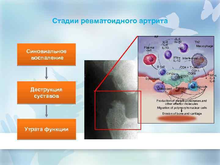 Стадии ревматоидного артрита RF Синовиальное воспаление IL-4 IL-6 IL-10 Plasma cell Th 0 Th