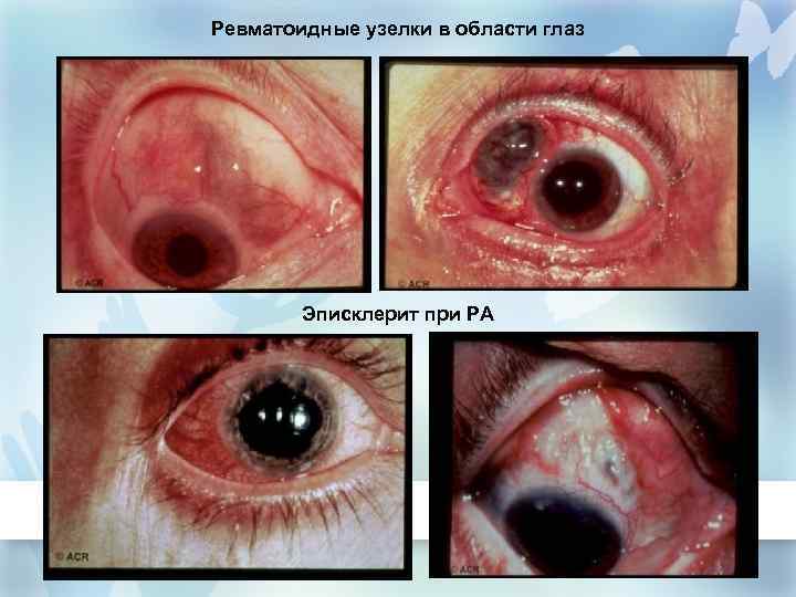 Ревматоидные узелки в области глаз Эписклерит при РА 