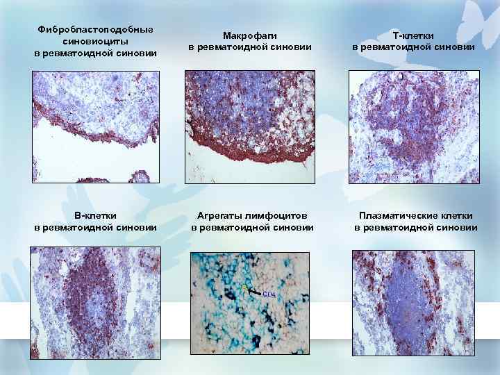 Фибробластоподобные синовиоциты в ревматоидной синовии Макрофаги в ревматоидной синовии Т-клетки в ревматоидной синовии В-клетки