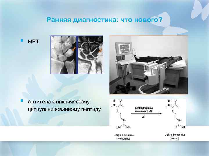 Ранняя диагностика: что нового? § МРТ § Антитела к циклическому цитрулинированному пептиду 