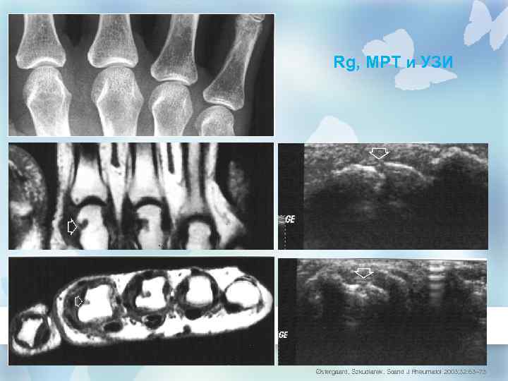 Rg, МРТ и УЗИ Østergaard, Szkudlarek. Scand J Rheumatol 2003; 32: 63– 73 