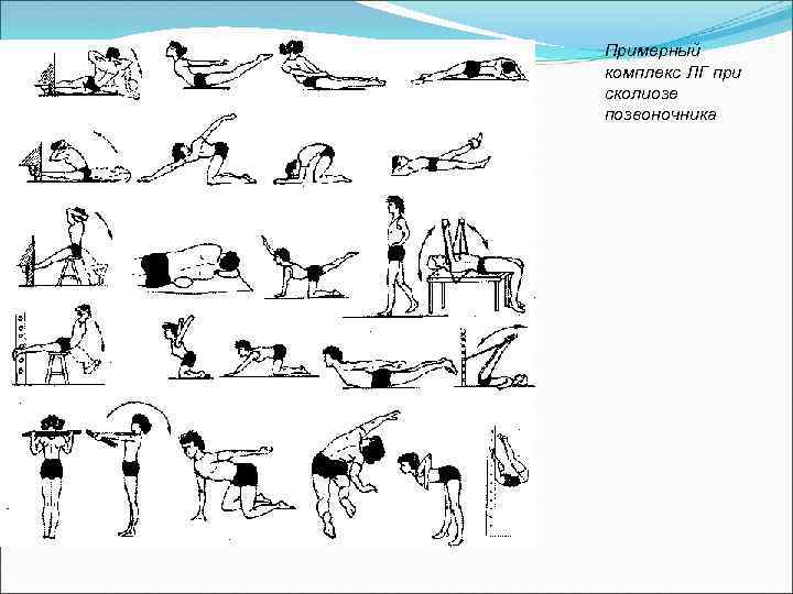 Примерный комплекс ЛГ при сколиозе позвоночника 