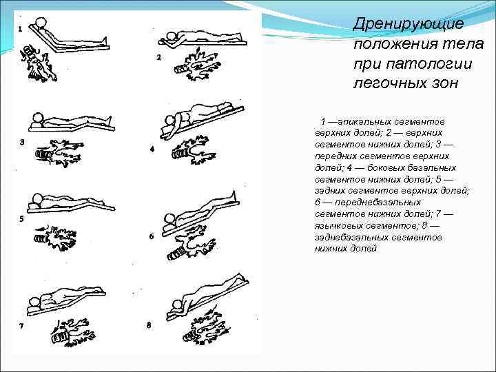 Дренажное положение квинке схема