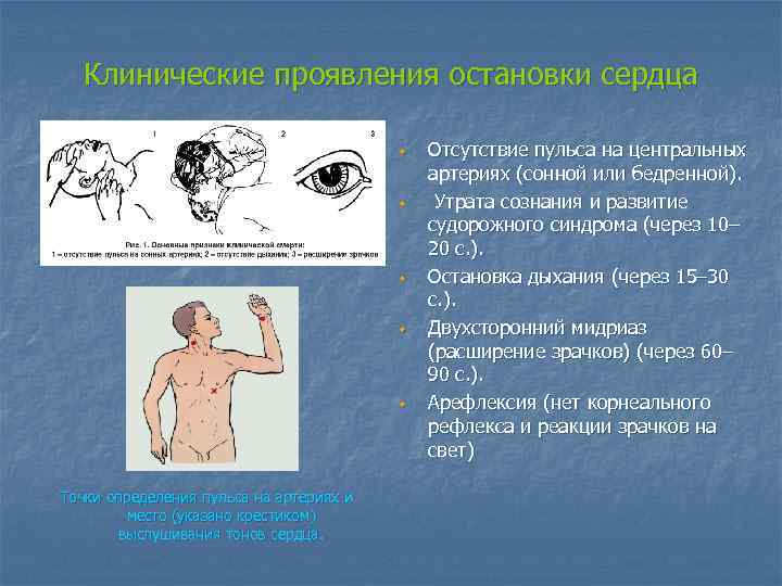 Клинические проявления остановки сердца w w w Точки определения пульса на артериях и место