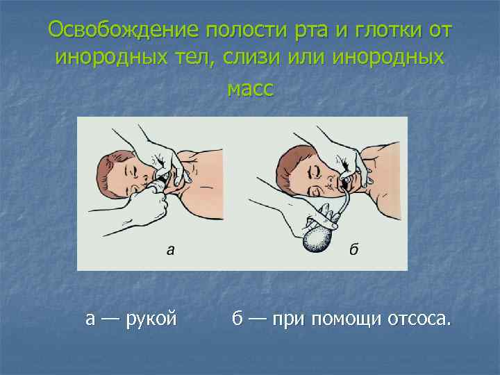 Освобождение полости рта и глотки от инородных тел, слизи или инородных масс а —