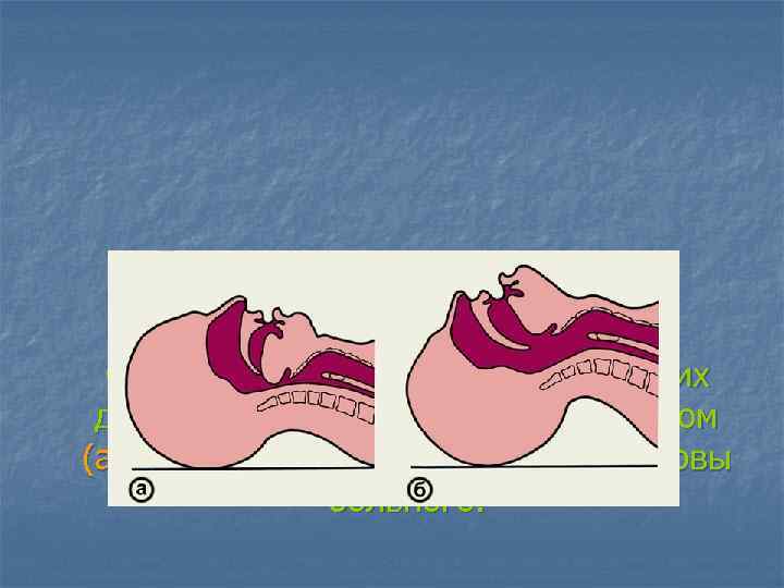 Схематическое изображение верхних дыхательных путей при неправильном (а) и правильном (б) положении головы больного.