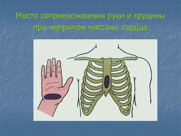 Место соприкосновения руки и грудины при непрямом массаже сердца 