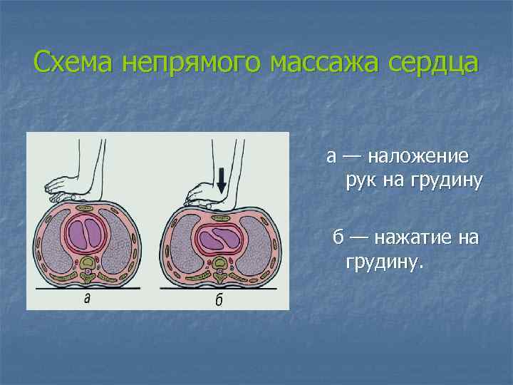 Схема непрямого массажа сердца а — наложение рук на грудину б — нажатие на