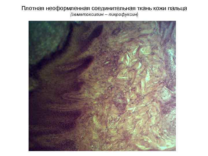 Плотная неоформленная соединительная ткань кожи пальца (гематоксилин – пикрофуксин) 