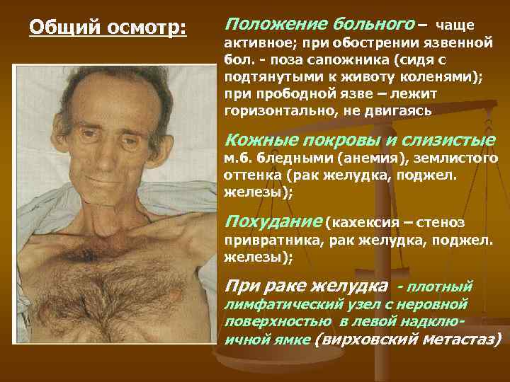 Общий осмотр: Положение больного – чаще активное; при обострении язвенной бол. - поза сапожника