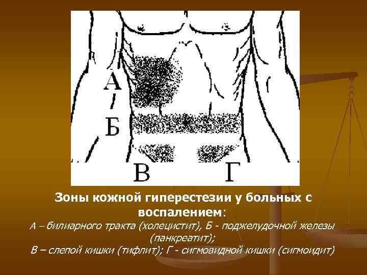 Зоны кожной гиперестезии у больных с воспалением: А – билиарного тракта (холецистит), Б -