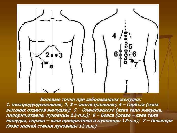 Болевые точки при заболеваниях желудка: 1. пилородуоденальная; 2, 3 – эпигастральные; 4 – Гербста