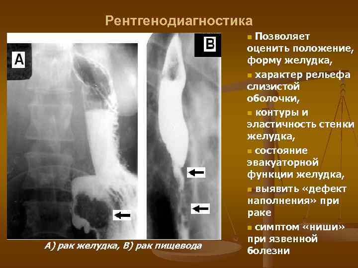 Рентгенодиагностика Позволяет оценить положение, форму желудка, n характер рельефа слизистой оболочки, n контуры и