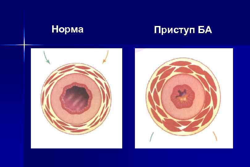 Норма Приступ БА 