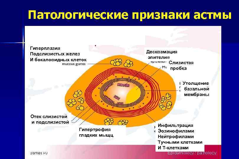 Патологические признаки астмы Гиперплазия Подслизистых желез И бокаловидных клеток Десквамация эпителия Слизистая пробка Утолщение