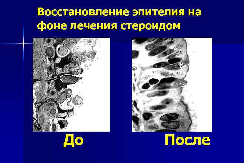 Восстановление эпителия на фоне лечения стероидом До После 