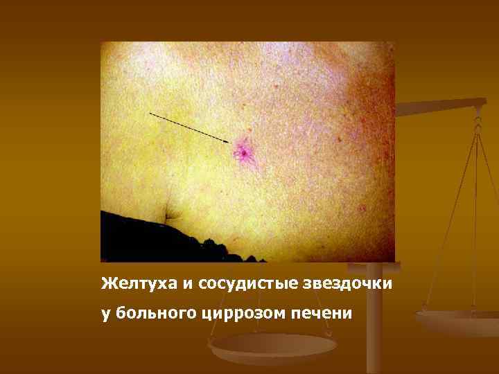 Желтуха и сосудистые звездочки у больного циррозом печени 