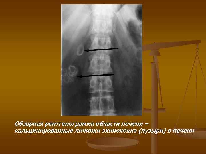 Обзорная рентгенограмма области печени – кальцинированные личинки эхинококка (пузыри) в печени 