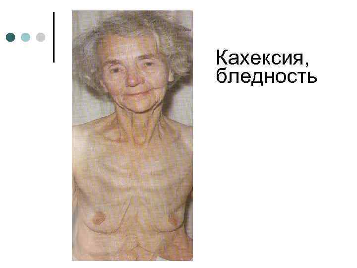 Кахексия, бледность 