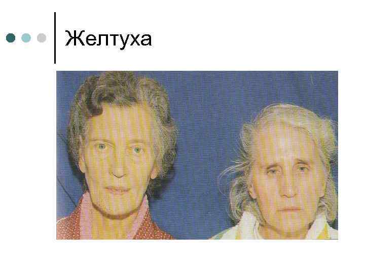 Желтуха 