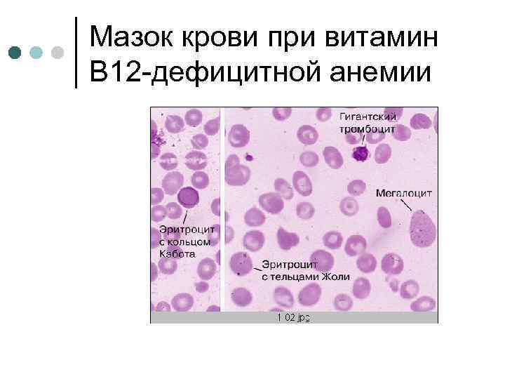 Мазок крови при витамин В 12 -дефицитной анемии 