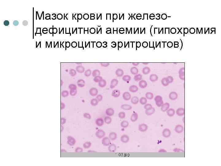 Мазок крови при железодефицитной анемии (гипохромия и микроцитоз эритроцитов) 