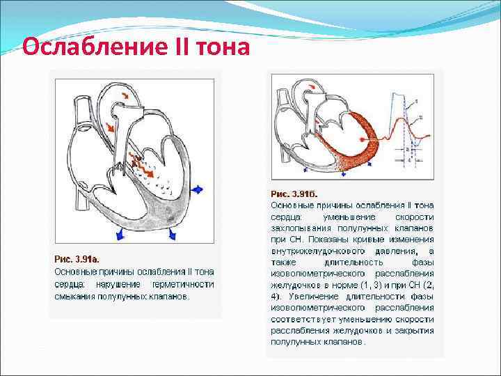 Ослабление II тона 